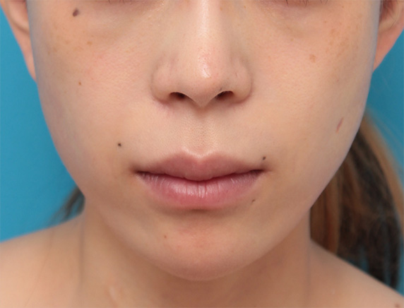 顔が長く見えないように顎先をシャープに尖らせるように出した症例写真の術前術後画像,After（6ヶ月後）,ba_ago27_a01.jpg