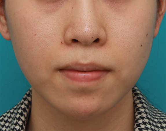 口元が出て顎が引っ込んでいる女性に顎シリコンプロテーゼを入れて顎を出した症例写真,After（6ヶ月後）,ba_ago24_a01.jpg