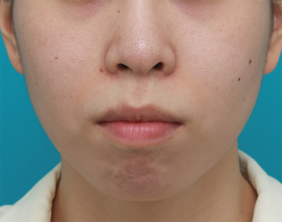 症例写真,口元が出て顎が引っ込んでいる女性に顎シリコンプロテーゼを入れて顎を出した症例写真,Before,ba_ago24_b.jpg