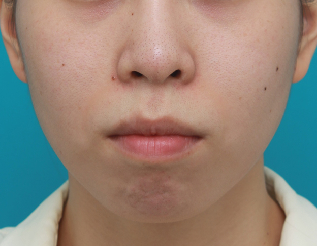 症例写真,口元が出て顎が引っ込んでいる女性に顎シリコンプロテーゼを入れて顎を出した症例写真,手術前,mainpic_ago03a.jpg