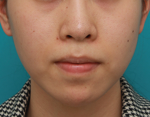 症例写真,口元が出て顎が引っ込んでいる女性に顎シリコンプロテーゼを入れて顎を出した症例写真,6ヶ月後,mainpic_ago03d.jpg