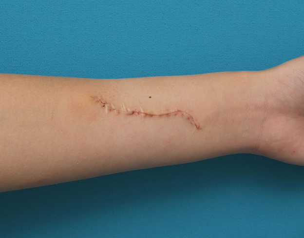 症例写真,リストカットの傷跡を2回に分けて完全に切除縫縮した症例写真,1回目手術後1週間,mainpic_keisei17c.jpg