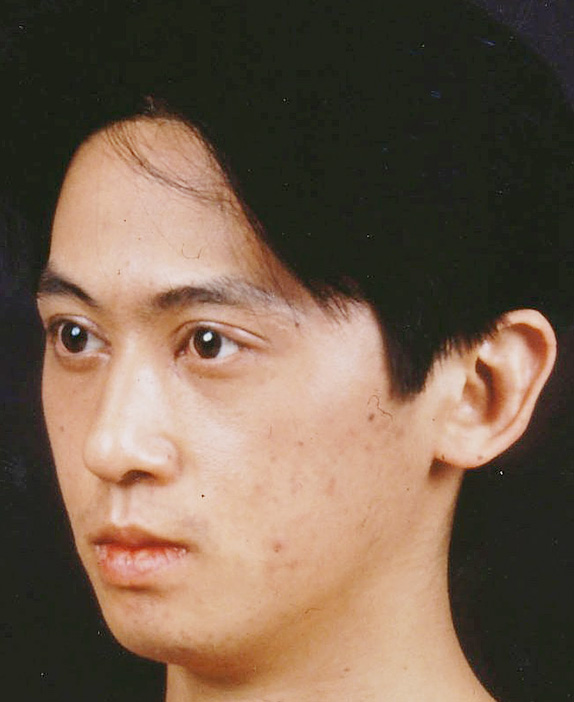 症例写真,あご形成(シリコンプロテーゼ)の症例写真 二重まぶた・全切開法も施行,After,ba_ago11_b.jpg