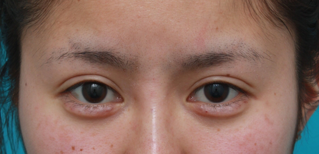 症例写真,ミニ切開法で二重を作った後、ヒアルロン酸で大きめな涙袋を作った症例写真,注射直後,mainpic_namida03b.jpg