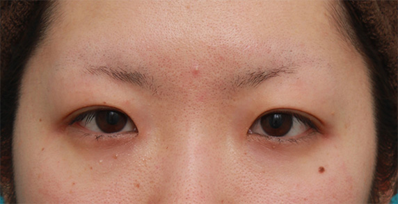 症例写真,あまり気づかれないようにわずかに涙袋ヒアルロン酸注射をした症例写真,Before,ba_namida14_b.jpg