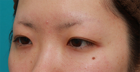 症例写真,あまり気づかれないようにわずかに涙袋ヒアルロン酸注射をした症例写真,Before,ba_namida15_b.jpg