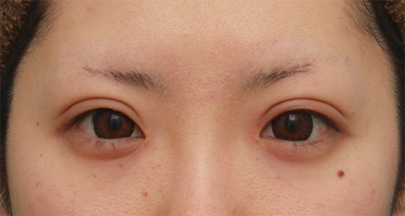 症例写真,涙袋ヒアルロン酸注射2回目の腫れが引いていくダウンタイム経過症例,After（1ヶ月後）,ba_namida16_b.jpg