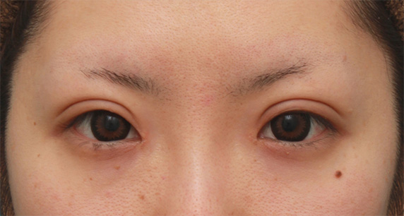 症例写真,涙袋ヒアルロン酸注射2回目の腫れが引いていくダウンタイム経過症例,Before,ba_namida16_b.jpg