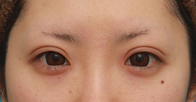 症例写真,涙袋ヒアルロン酸注射2回目の腫れが引いていくダウンタイム経過画像,1ヶ月後,mainpic_namida05c.jpg