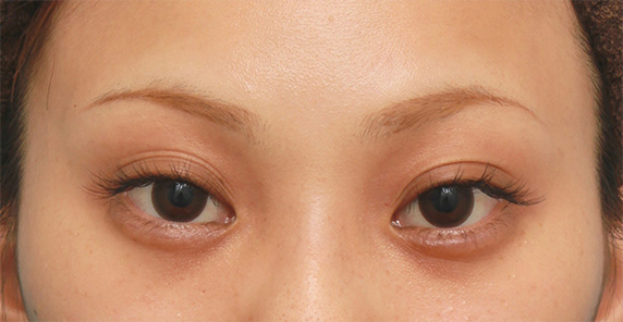 キツいつり目にヒアルロン酸注射で涙袋を作り、優しい印象の目にした症例写真の術前術後,After（3ヶ月後）,ba_namida17_a01.jpg