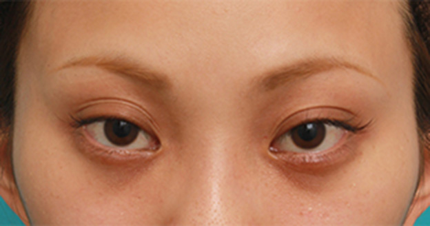 症例写真,キツいつり目にヒアルロン酸注射で涙袋を作り、優しい印象の目にした症例写真の術前術後,注射前,mainpic_namida06a.jpg
