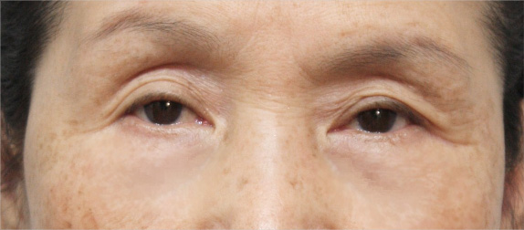 症例写真,目の下のクマ治療　脂肪除去,After,ba_shibo05_b.jpg