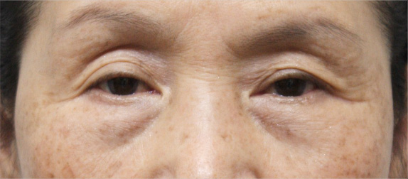 症例写真,目の下のクマ治療　脂肪除去,Before,ba_shibo05_b.jpg