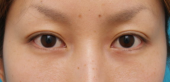 目の下の脂肪取り,目の下のクマ治療,目の下のクマ治療　脂肪除去,After（1週間後）,ba_kuma07_a01.jpg