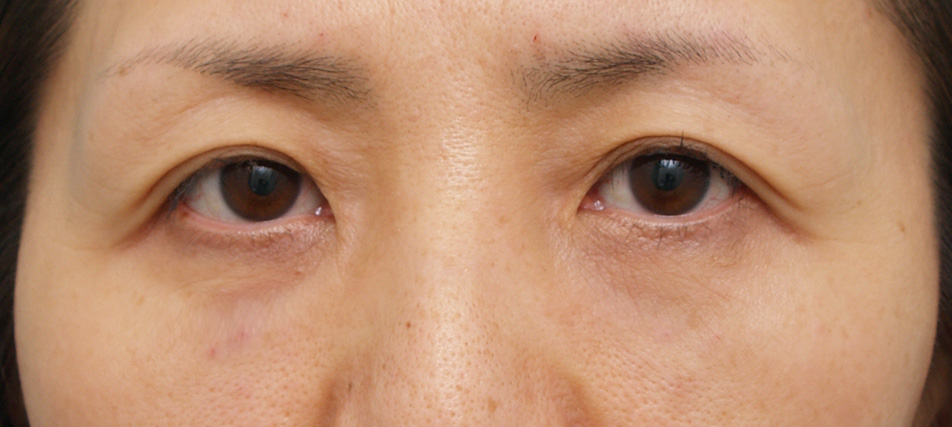 目の下のクマ治療,注射式シワ取り 長期持続型ヒアルロン酸注入,目の下のクマ治療　ヒアルロン酸注入,After,ba_kuma06_a01.jpg