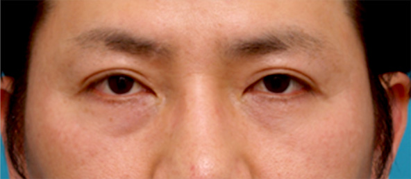 目の下のクマ治療,注射式シワ取り 長期持続型ヒアルロン酸注入,目の下のくぼみにヒアルロン酸を注射した症例写真,Before,ba_kuma13_b.jpg