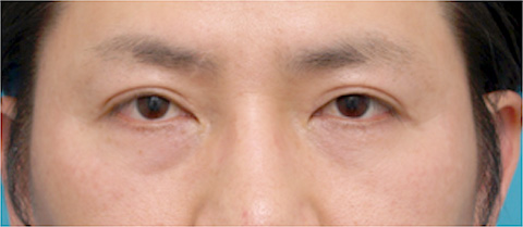 注射式シワ取り 長期持続型ヒアルロン酸注入,目の下のくぼみにヒアルロン酸を注射した症例写真,注射前,mainpic_kuma04a.jpg