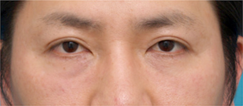 注射式シワ取り 長期持続型ヒアルロン酸注入,目の下のくぼみにヒアルロン酸を注射した症例写真,注射直後,mainpic_kuma04b.jpg
