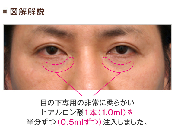 目の下のくぼみにヒアルロン酸を注射した症例写真 美容整形の高須クリニック 東京赤坂 横浜 名古屋 大阪