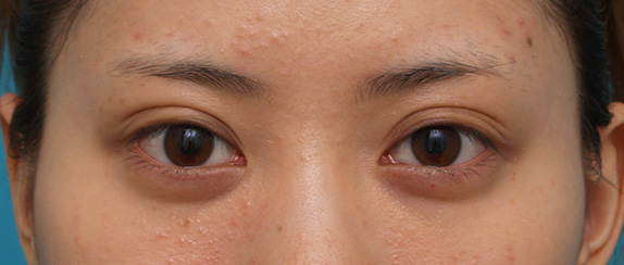 注射式シワ取り 長期持続型ヒアルロン酸注入,目の下のくぼみにヒアルロン酸注射した症例写真,After,ba_kuma14_b.jpg