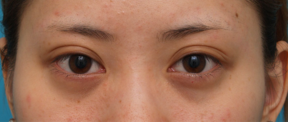 注射式シワ取り 長期持続型ヒアルロン酸注入,目の下のくぼみにヒアルロン酸注射した症例写真,Before,ba_kuma14_b.jpg