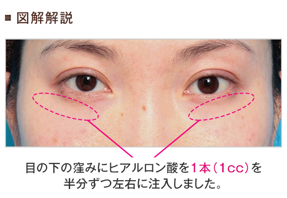 目の下のクマの原因の窪みにヒアルロン酸注射をして改善させた症例写真の術前術後画像 美容整形の高須クリニック 東京赤坂 横浜 名古屋 大阪