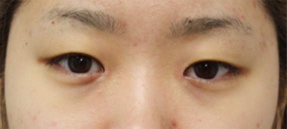 蒙古ひだ形成・目頭切開後の修正症例 他院での二重まぶた・目もと手術の修正,After（1ヶ月後）,ba_hida02_a01.jpg