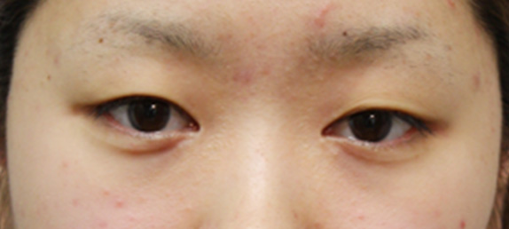 蒙古ひだ形成・目頭切開後の修正症例 他院での二重まぶた・目もと手術の修正,Before,ba_hida02_b.jpg