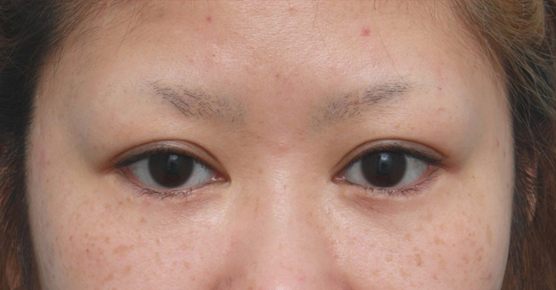 症例写真,他院で目頭切開を必要以上に切り過ぎてきつくなった目を蒙古襞形成で修正した症例写真,手術前,mainpic_hida04a.jpg