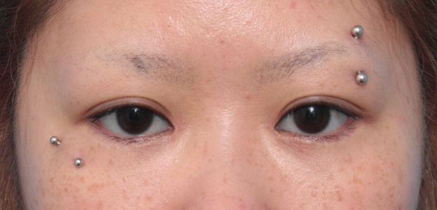 症例写真,他院で目頭切開を必要以上に切り過ぎてきつくなった目を蒙古襞形成で修正した症例写真,2ヶ月後,mainpic_hida04d.jpg