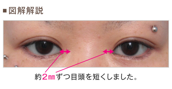 高須 クリニック 目頭 切開