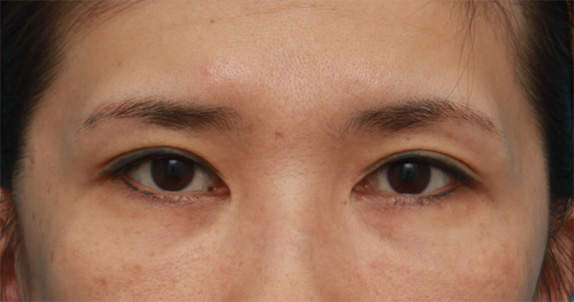 症例写真,他院で受けた目頭切開を蒙古襞形成で修正手術した症例写真の術前術後の画像の解説,Before,ba_hida06_b.jpg