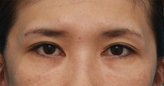 他院で受けた目頭切開を蒙古襞形成で修正手術した症例写真の術前術後の画像の解説 美容整形の高須クリニック 東京赤坂 横浜 名古屋 大阪 他院で受けた目頭切開を蒙古襞形成で修正手術した症例写真の術前術後の画像の解説 美容整形の高須クリニック 東京赤坂 横浜 名古屋 大阪
