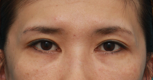 症例写真,他院で受けた目頭切開を蒙古襞形成で修正手術した症例写真の術前術後の画像の解説,手術前,mainpic_hida05a.jpg