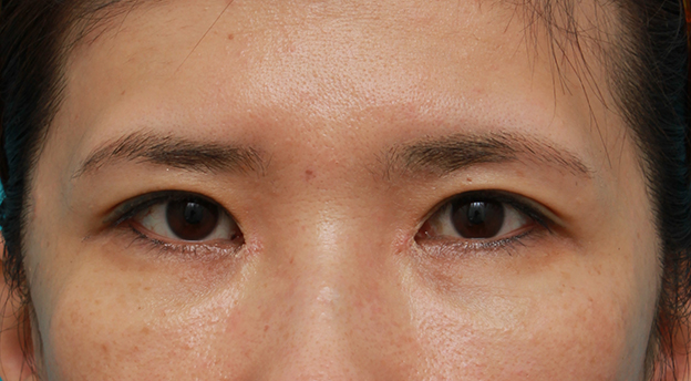 症例写真,他院で受けた目頭切開を蒙古襞形成で修正手術した症例写真の術前術後の画像の解説,3週間後,mainpic_hida05d.jpg