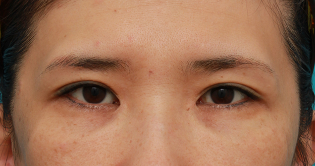 症例写真,他院で受けた目頭切開を蒙古襞形成で修正手術した症例写真の術前術後の画像の解説,3ヶ月後,mainpic_hida05e.jpg