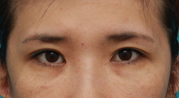 症例写真,他院で受けた目頭切開を蒙古襞形成で修正手術した症例写真の術前術後の画像の解説,6ヶ月後,mainpic_hida05f.jpg