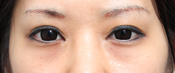 垂れ目（パンダ目）形成（グラマラスライン／下眼瞼下制術）の症例 20代女性の術後1週間、抜糸時の様子,Before,ba_panda02_b.jpg