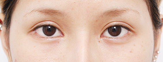垂れ目（パンダ目）形成（グラマラスライン／下眼瞼下制術）の症例 癒し系の目もとが憧れの20代女性,Before,ba_panda03_b.jpg