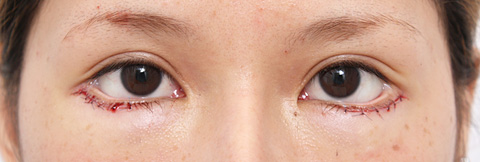症例写真,垂れ目（パンダ目）形成（グラマラスライン／下眼瞼下制術）の症例 癒し系の目もとが憧れの20代女性,施術直後,mainpic_panda03b.jpg