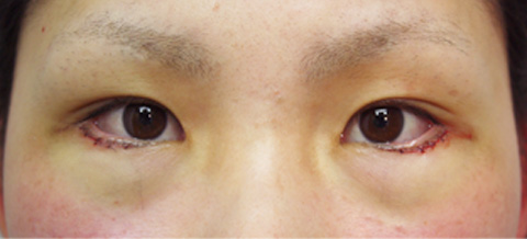 症例写真,垂れ目（パンダ目）形成（グラマラスライン／下眼瞼下制術）の症例 きつく見られるつり目がコンプレックスだった女性,施術直後,mainpic_panda01b.jpg
