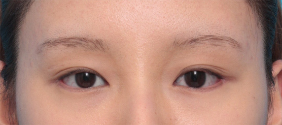 垂れ目形成 目尻切開で目が一回り大きくなり 優しい目元になった症例写真 美容整形の高須クリニック 東京赤坂 横浜 名古屋 大阪