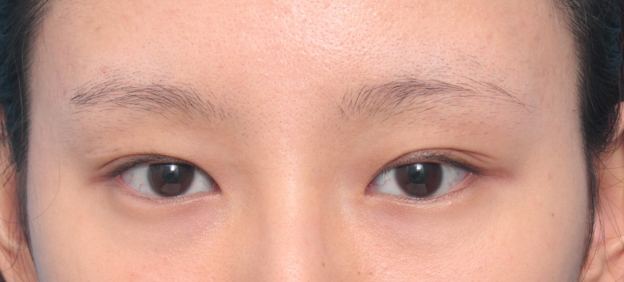 症例写真,垂れ目形成+目尻切開で目が一回り大きくなり、優しい目元になった症例写真,手術前,mainpic_panda04a.jpg