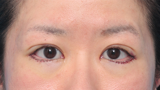症例写真,目尻切開+たれ目形成術（グラマラスライン）で目を外側と下方に大きくした症例写真,手術直後,mainpic_panda06b.jpg