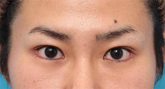 症例写真,目尻切開+タレ目形成（グラマラスライン）で目を一回り大きくした男性の症例写真の術前術後画像,6ヶ月後,mainpic_panda07e.jpg