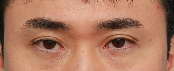 症例写真,ボツリヌストキシン注射で下まぶたのラインを下に広げて目を大きくした症例,Before,ba_panda_botox01_b.jpg