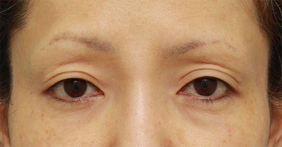ボツリヌストキシン注射（目を下に大きくする、垂れ目形成）で目を大きくした40代女性の症例写真の術前術後画像,After（1週間後）,ba_panda_botox02_a01.jpg