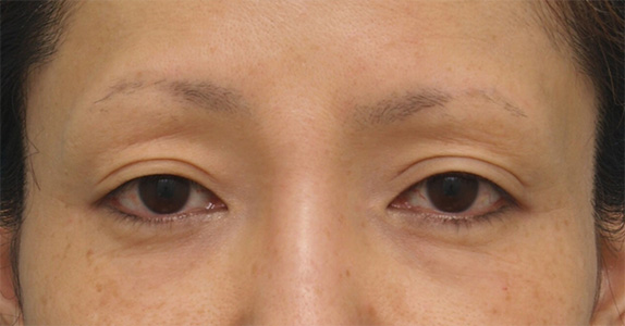 ボツリヌストキシン注射（目を下に大きくする、垂れ目形成）で目を大きくした40代女性の症例写真の術前術後画像,Before,ba_panda_botox02_b.jpg