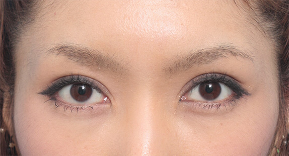 手術 失敗 二重まぶた 眼瞼下垂の手術で上瞼をひらきぱっちり大きな目に ：高須クリニック