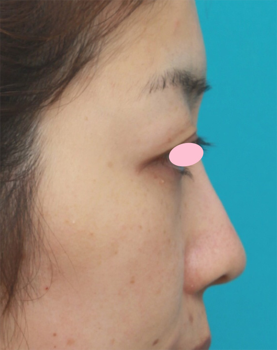 症例写真,耳介軟骨移植で丸い鼻先を斜め下方向に綺麗に出した20代女性の症例写真の術前術後画像,After（6ヶ月後）,ba_jikai43_b.jpg